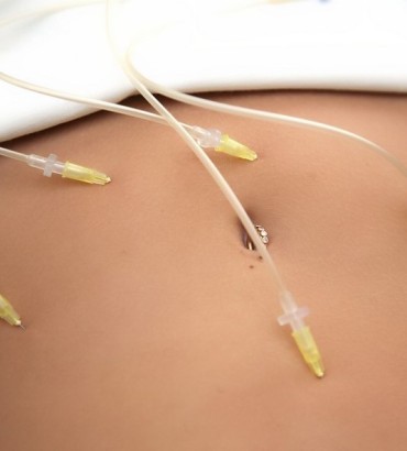 Озонотерапия (внутривенно)